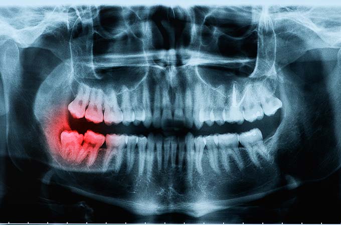 Wisdom Teeth Removal X-Ray